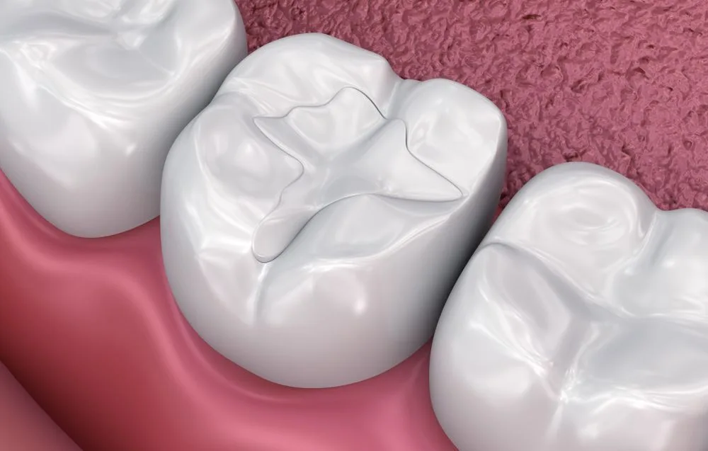 Dental fissure fillings illustrated on a molar — dental clinic in Buderim, QLD