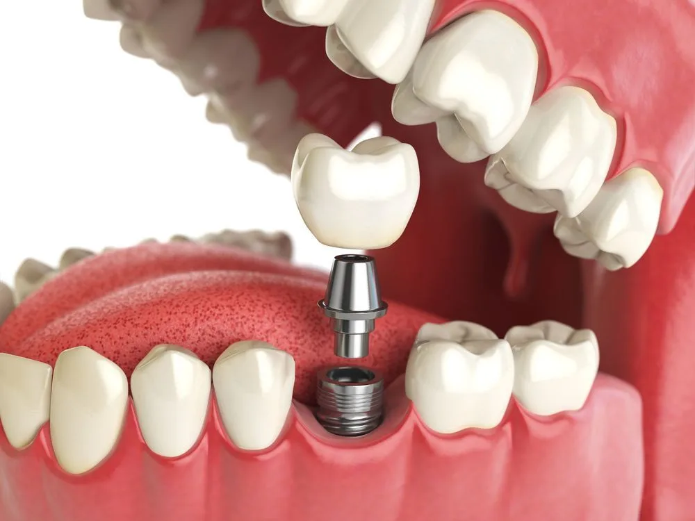 Diagram of a dental implant, abutment and crown in the jaw — dental clinic in Buderim, QLD