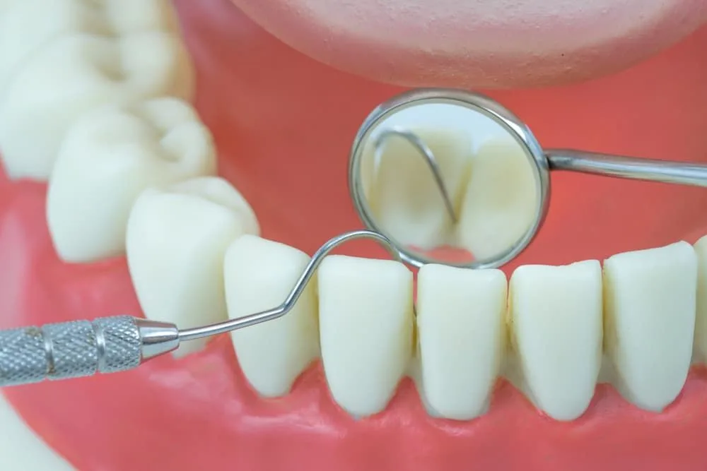 Dental model being cleaned and inspected with a mirror and probe — dental clinic in Buderim, QLD
