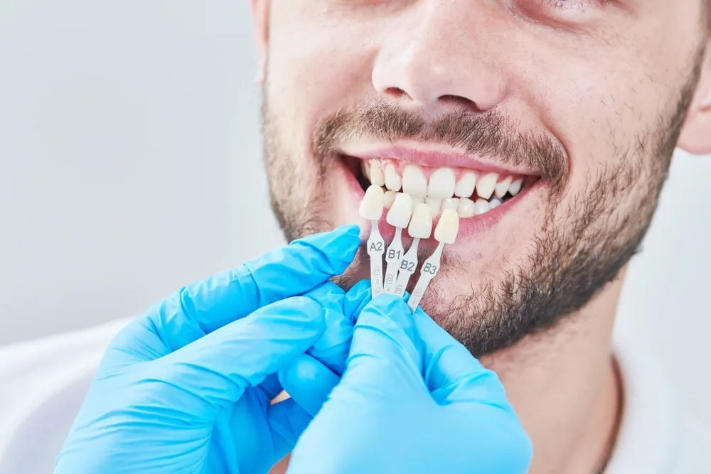 Matching the colour of tooth enamel with a shade chart — dental clinic in Buderim, QLD