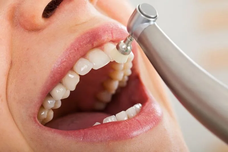 Professional dental cleaning in progress — dental clinic in Buderim, QLD